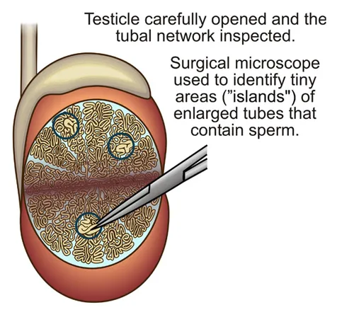 a diagram of testicle carefully opened and the tubal network inspected