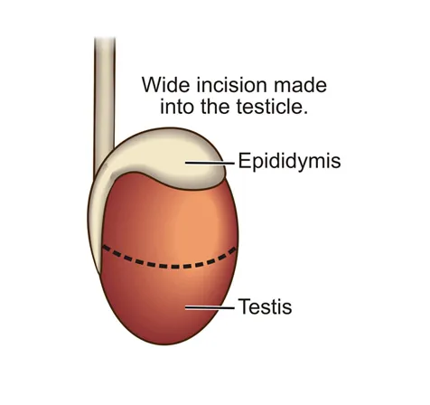 a diagram of a wide incision is made through the testicular capsule