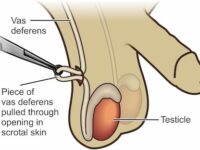vasectomy procedure