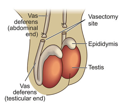 casic anatomy of vasectomy