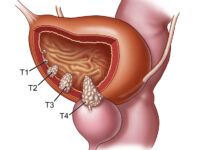 a diagram of bladder cancer