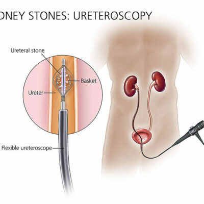 kidney stones removal