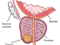 diagram of localised prostate cancer
